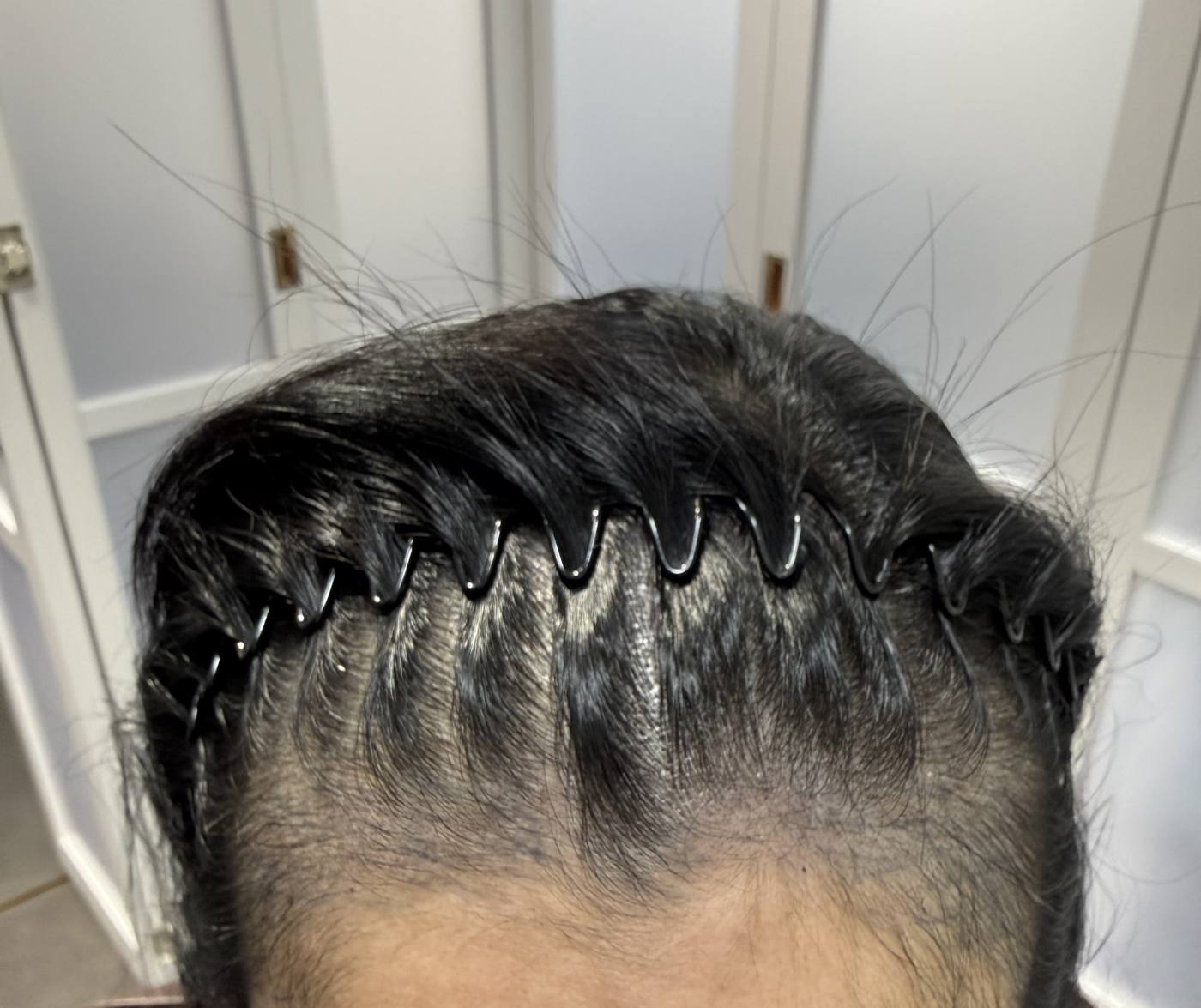 The same hairline after the first session