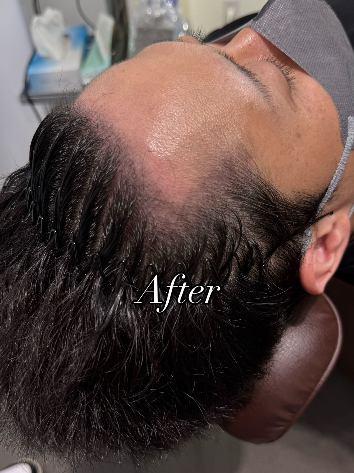 The same hairline after treatment