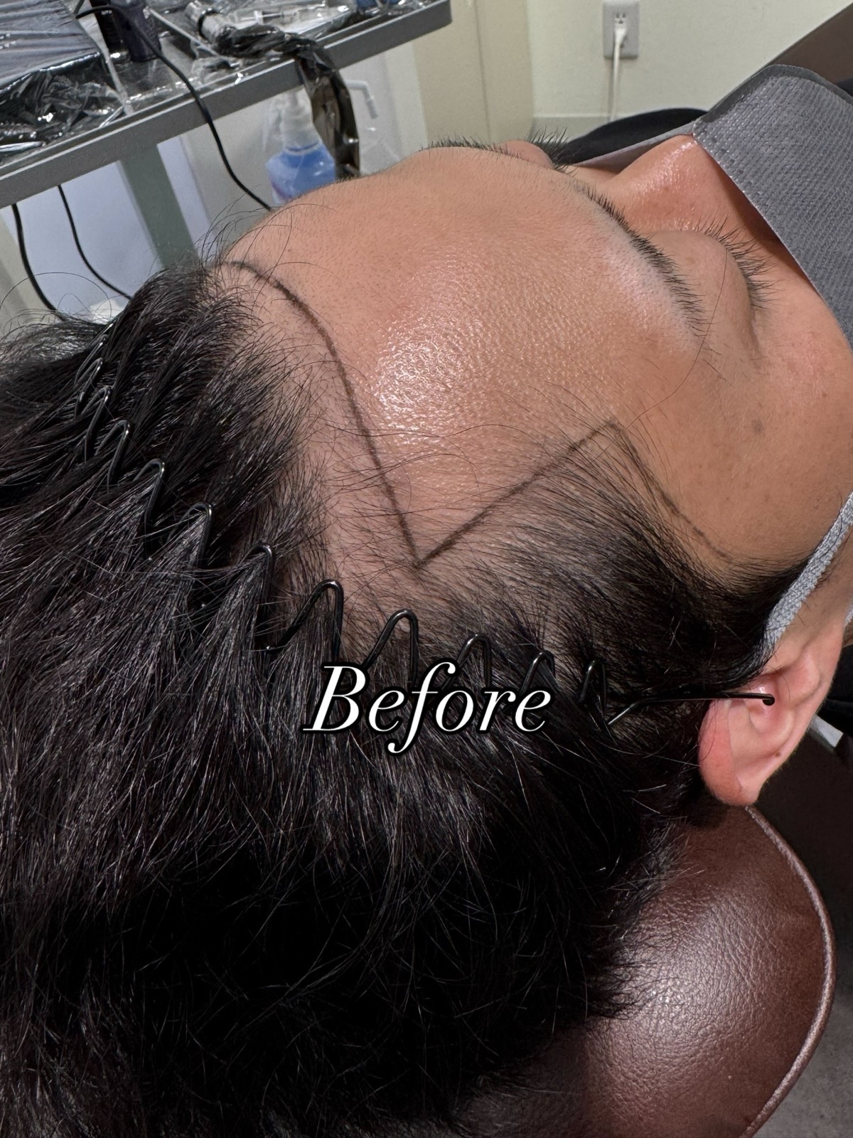 A man's hairline before treatment