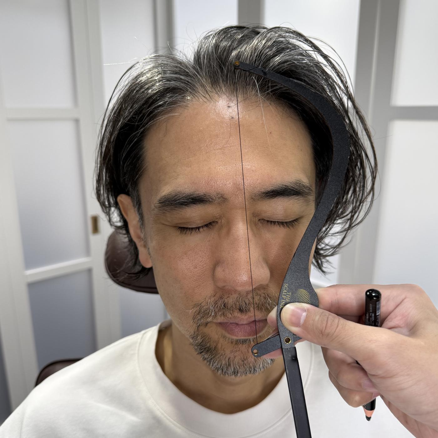 A face being measured with a golden ratio caliper to set the treatment area
