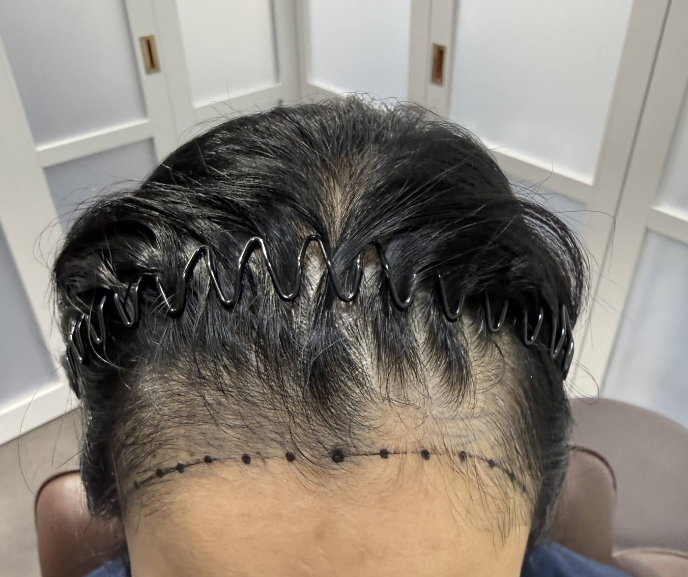 A woman's hairline marked out before the first session