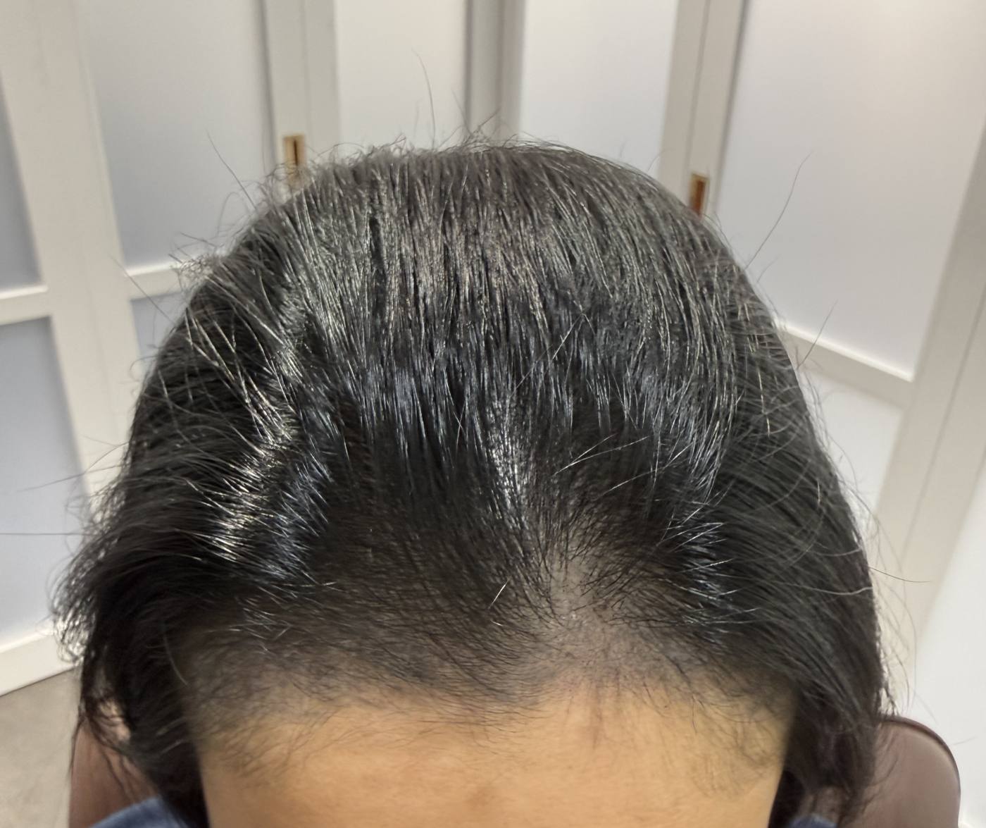 The same hairline after the second session, hair worn down