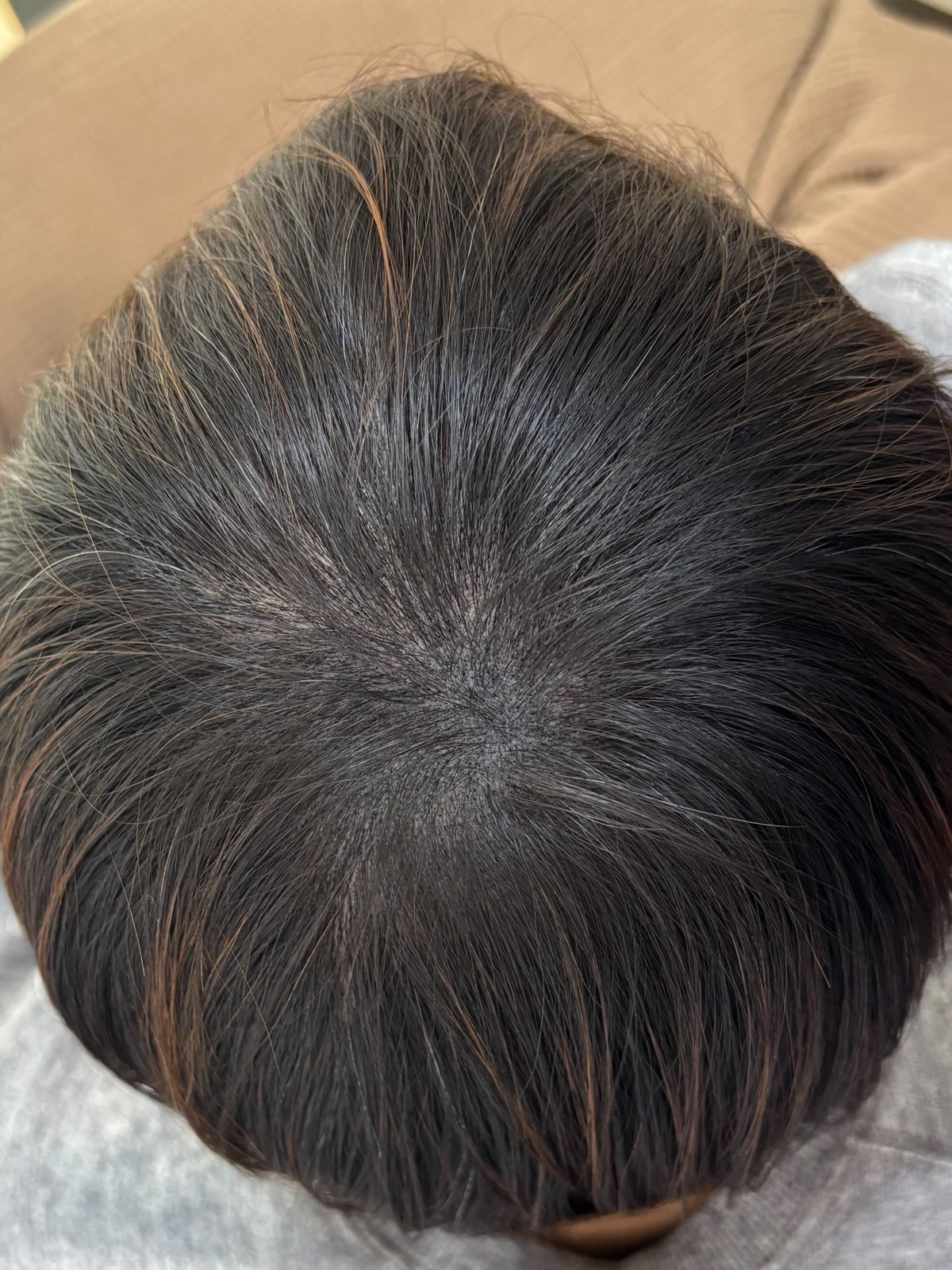 The same crown after treatment, seen from directly above