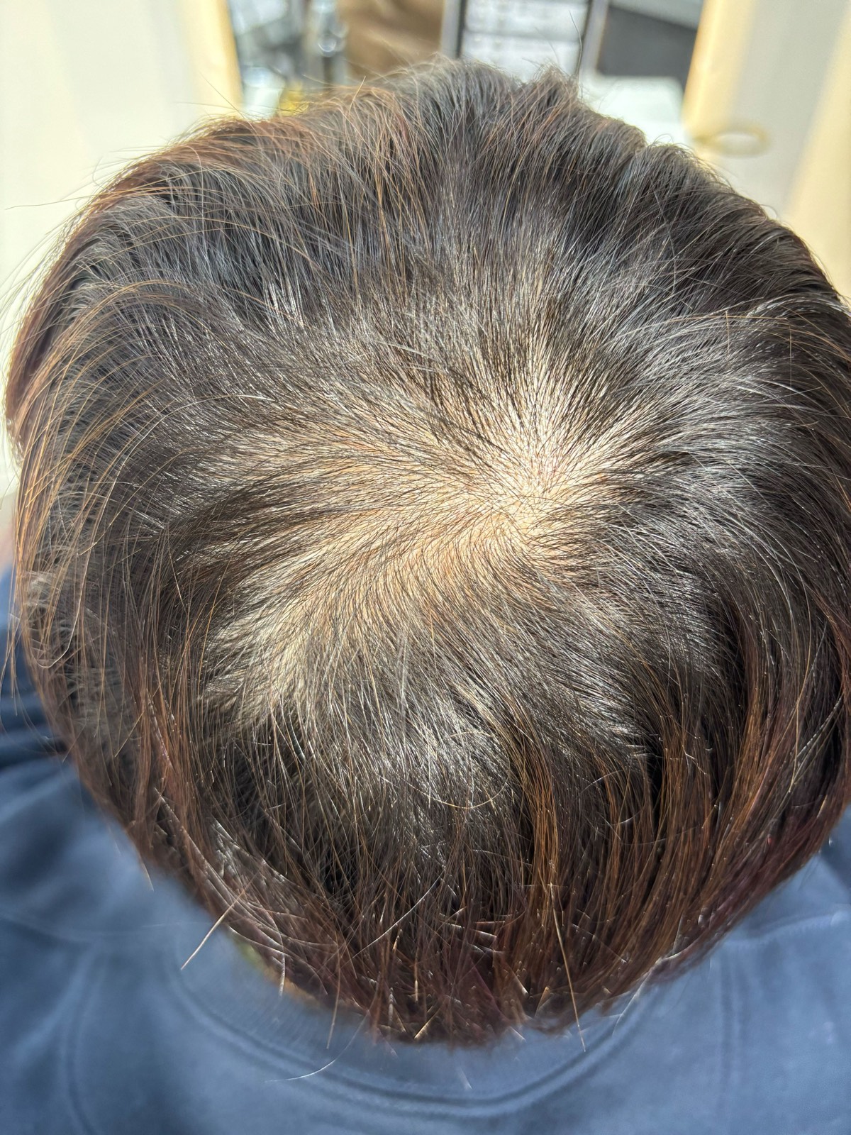 A woman's crown before treatment, seen from directly above