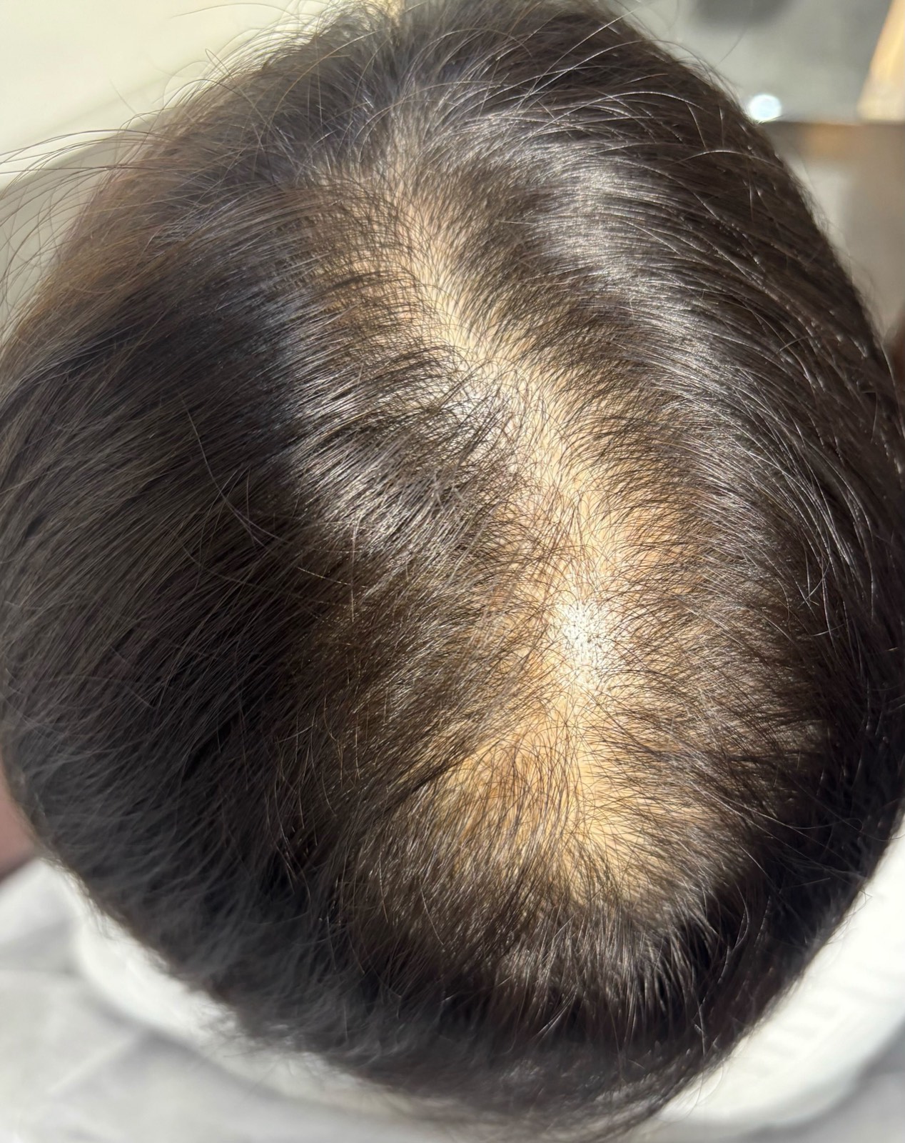 A woman's parting before treatment, with the scalp showing through