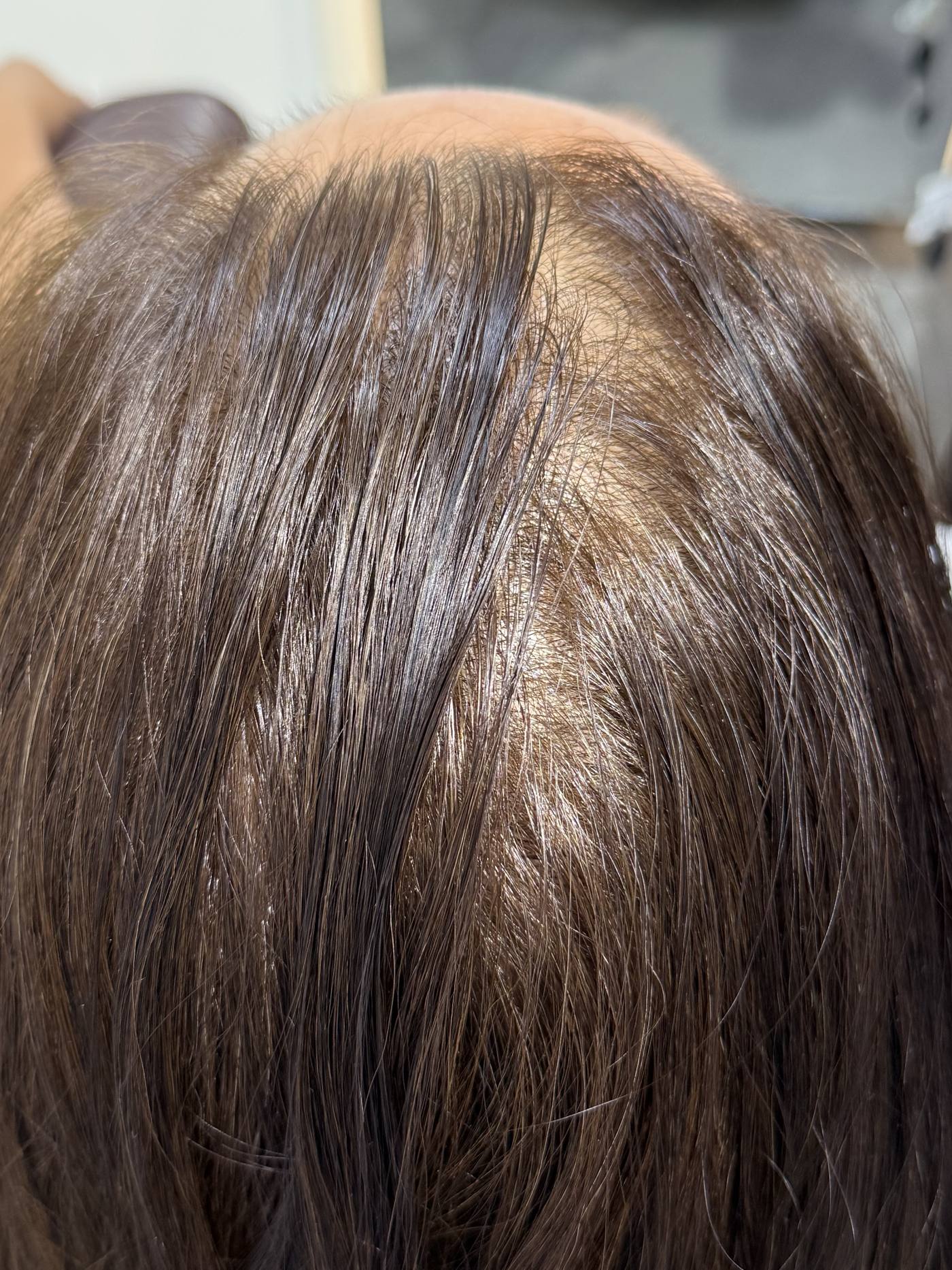 A woman's parting before treatment, with the scalp showing through